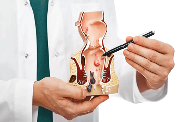 Picture of Anal Disorder Care ( Piles, Fissure, Fistula )
